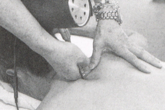 深部振動療法（マイオセラピー）